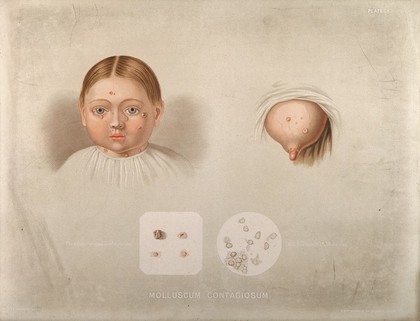 Diseased skin on the face of a girl suffering from molluscum contagiosum, shown beside a diseased breast, with two details below showing sebaceous follicles and cells as seen under a microscope. Chromolithograph by E. Burgess (?), 1850/1880?.