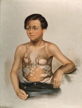 Discoloured areas of skin on the torso of a boy suffering from leucoderma (vitiligo). Chromolithograph by E. Burgess, 1850/1880?.