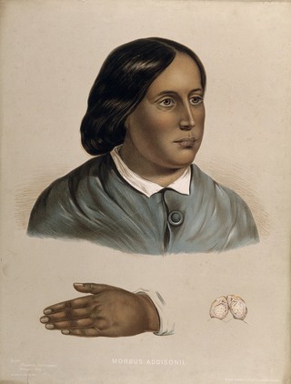 Face and hand of a woman suffering from morbus addisonii (bronzed skin disease), with a detail showing an unidentified organ (?). Chromolithograph after W. Hurst, 1850/1880?.