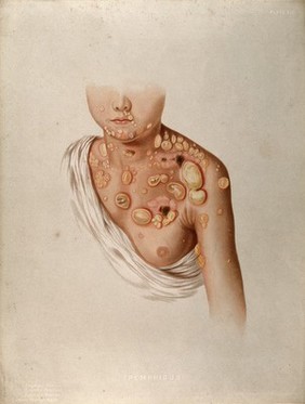 Diseased skin and large blisters on the chest, neck, shoulders and face of a child suffering from pemphigus. Chromolithograph by E. Burgess, 1850/1880?.