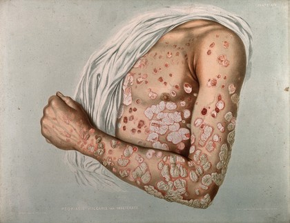 Diseased skin on the chest and arm of a man suffering from psoriasis. Chromolithograph by E. Burgess, 1850/1880?.