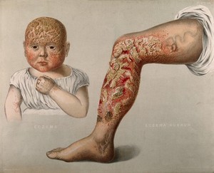 view Diseased skin on the face of a baby suffering from eczema, shown beside the leg of a sufferer of eczema rubrum. Chromolithograph by E. Burgess, 1850/1880?.