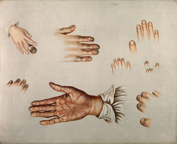 Diseased skin and nails on the hands and fingers of sufferers of a variety of diseases, including psoriasis and syphilis. Chromolithograph by E. Burgess, 1850/1880?.