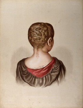 Diseased skin on scalp and neck of a girl suffering from porrigo contagiosa. Chromolithograph by E. Burgess, 1850/1880?.