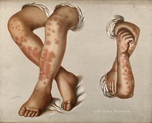 view Diseased skin on the forearms and lower legs of a patient suffering from erythema nodosum. Chromolithograph by E. Burgess, 1850/1880?.