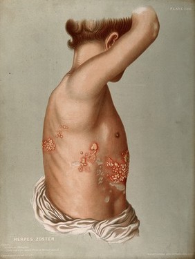 Diseased skin and blisters on the torso of a young man or boy suffering from herpes zoster (common shingles). Chromolithograph by E. Burgess, 1850/1880?.