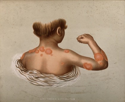 Areas of diseased skin the neck, back, shoulders and arm of a boy suffering from erythema circinatum. Chromolithograph by E. Burgess, 1850/1880?.