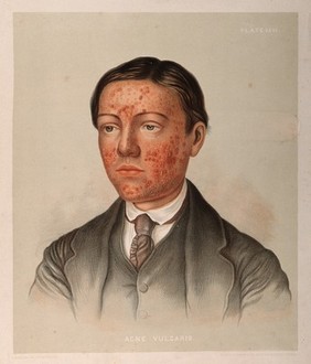 Skin on the face of a young man suffering from acne vulgaris. Chromolithograph by E. Burgess, 1850/1880?.