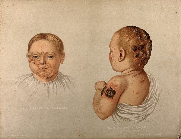 Severely diseased skin on the face, buttocks and genitals of a baby boy suffering from inherited syphilis. Chromolithograph by E. Burgess, 1850/1880?.
