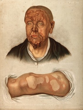 Severely diseased skin on the face, buttocks and genitals of a baby boy suffering from inherited syphilis. Chromolithograph by E. Burgess, 1850/1880?.