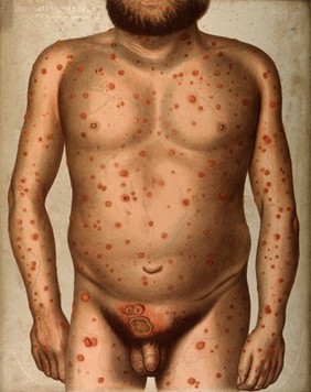 Rash of indurated chancres on the body and groin of a man. Chromolithograph by E. Burgess, 1850/1880?.