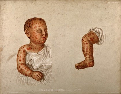 Severely diseased skin on the face, buttocks and genitals of a baby boy suffering from inherited syphilis. Chromolithograph by E. Burgess, 1850/1880?.