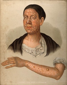 Severely diseased skin on the face, buttocks and genitals of a baby boy suffering from inherited syphilis. Chromolithograph by E. Burgess, 1850/1880?.