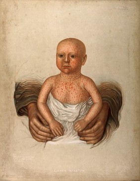 Severely diseased skin on the face, buttocks and genitals of a baby boy suffering from inherited syphilis. Chromolithograph by E. Burgess, 1850/1880?.