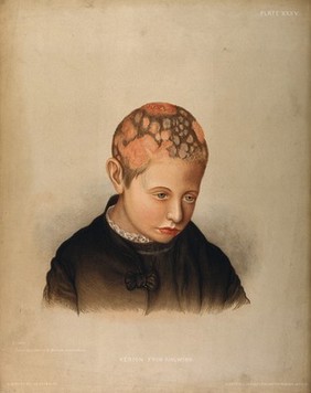 Severely diseased skin on the face, buttocks and genitals of a baby boy suffering from inherited syphilis. Chromolithograph by E. Burgess, 1850/1880?.