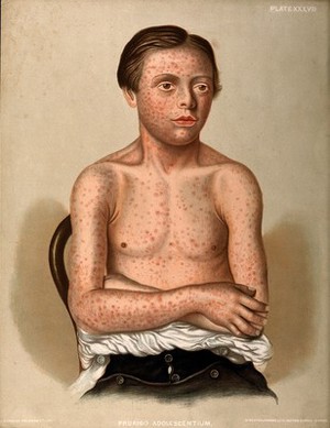 view Rash of sores on the face, arms and torso of a boy suffering from prurigo adolescentium. Chromolithograph by E. Burgess, 1850/1880?.