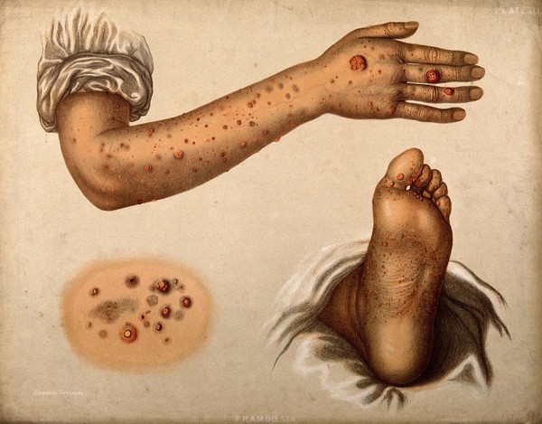 Rashes of diseased skin on the arm, hand and foot of a patient suffering from framboesia (yaws). Chromolithograph by E. Burgess, 1850/1880?