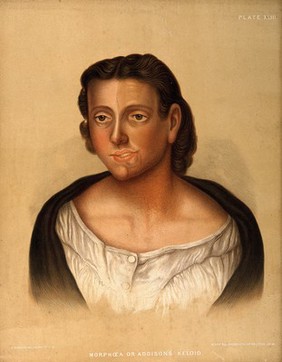 Severely diseased skin on the face, buttocks and genitals of a baby boy suffering from inherited syphilis. Chromolithograph by E. Burgess, 1850/1880?.