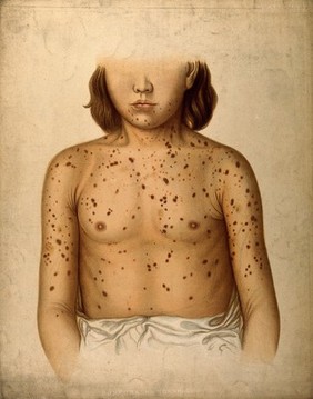 Areas of diseased skin on the scalp of a child affected by kerion from ringworm. Chromolithograph by E. Burgess, 1850/1880?.