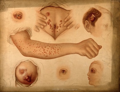 Areas of diseased skin on the scalp of a child affected by kerion from ringworm. Chromolithograph by E. Burgess, 1850/1880?.