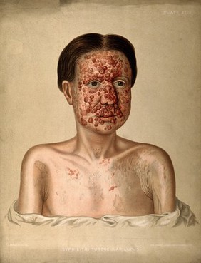 Severely diseased skin on the face, buttocks and genitals of a baby boy suffering from inherited syphilis. Chromolithograph by E. Burgess, 1850/1880?.