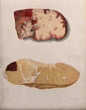 Two sections of a diseased part of the body, numbered for key. Chromolithograph by West Newman & Co. after E.W. (?) Tuson and J.G. Westmacott, ca. 1880.