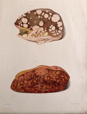 Two sections of a diseased part of the body, numbered for key. Chromolithograph by West Newman & co. after J. F. Goodhart, c. 1880.