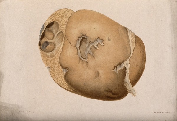 A section of a diseased part of the body. Chromolithograph by West Newman & co. after W. Hurst, c. 1880.