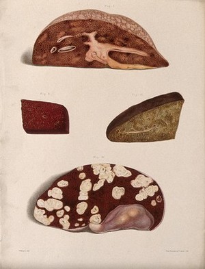 view Four sections of a diseased part of the body, numbered for key. Chromolithograph by West Newman & co. after W. Moxon, c. 1880.