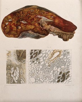 Three sections of a diseased part of the body, numbered for key. Chromolithograph by E. Burgess after W. Moxon, c. 1880.