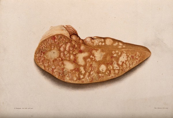 A section of a diseased part of the body. Chromolithograph by E. Burgess, c. 1880.