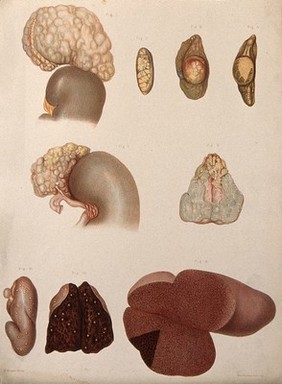 Several sections of diseased parts of the body, numbered for key. Chromolithograph by E. Burgess, c. 1880.