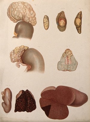 view Several sections of diseased parts of the body, numbered for key. Chromolithograph by E. Burgess, c. 1880.