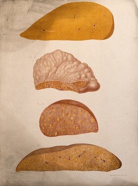 Four sections of a diseased part of the body, numbered for key. Chromolithograph, c. 1880.