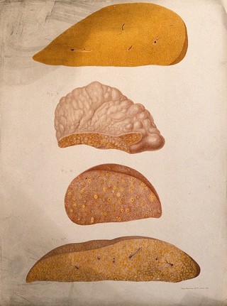Four sections of a diseased part of the body, numbered for key. Chromolithograph, c. 1880.