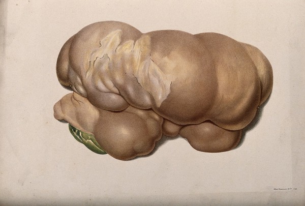 A diseased part of the body. Chromolithograph, c. 1880.