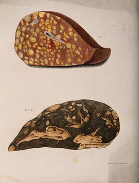 Two sections of a diseased part of the body, numbered for key. Chromolithograph, c. 1880.