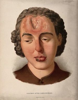 view Head of a woman with a large scar on her forehead. Chromolithograph, c. 1888.