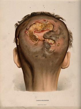 Head of a man with a skin disease on his scalp: back view, lettered for key. Chromolithograph, c. 1888.