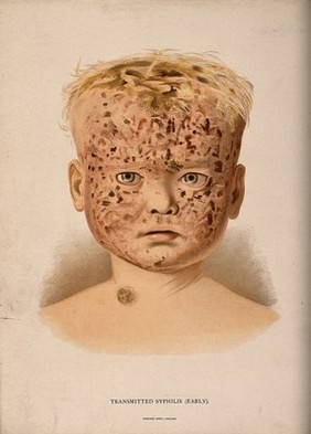 Head of a boy with a skin disease on his face and neck. Chromolithograph, c. 1888.