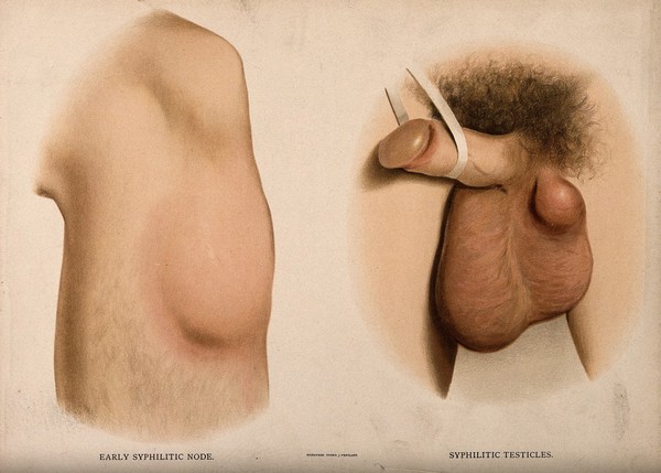 A section of leg with a swelling on the shin below the knee; and male genitalia with a lump on the testicles. Chromolithograph, c. 1888.