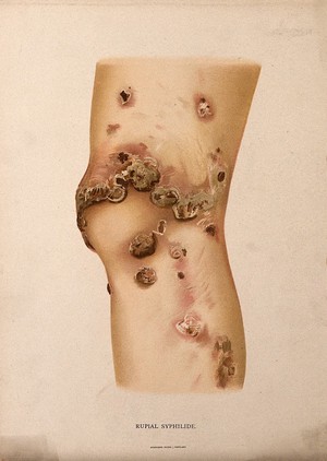 view A section of leg with a skin disease. Chromolithograph, c. 1888.