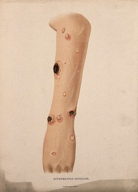 A section of forearm with a skin disease. Chromolithograph, c. 1888.