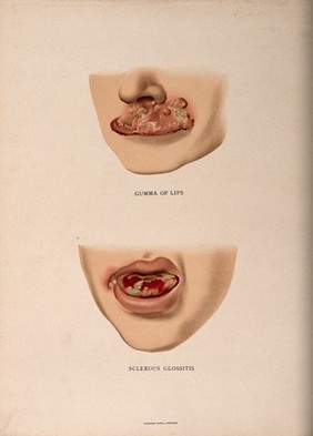 The lower half of a face with a skin disease on the top lip; and another with a diseased tongue. Chromolithograph, c. 1888.