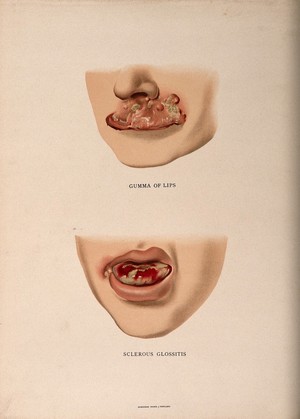 view The lower half of a face with a skin disease on the top lip; and another with a diseased tongue. Chromolithograph, c. 1888.