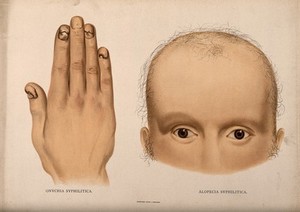 view A hand with cracked and diseased fingernails; and the upper half of a face with severe hair loss (missing brows and lashes). Chromolithograph, c. 1888.