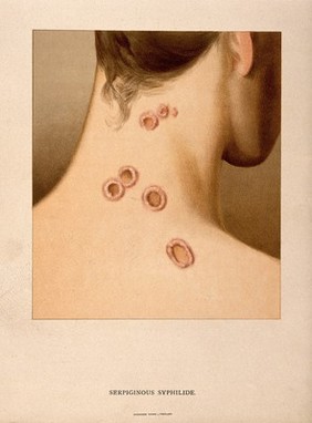 Neck and shoulders of a woman with a skin disease: back view. Chromolithograph, c. 1888.