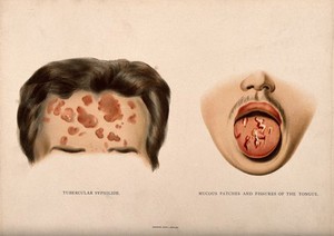 view The upper half of a face with a skin disease on the forehead; and the lower half of a face with a diseased tongue. Chromolithograph, c. 1888.