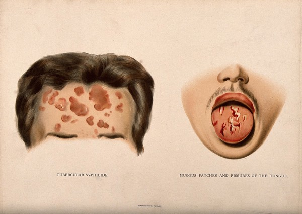 The upper half of a face with a skin disease on the forehead; and the lower half of a face with a diseased tongue. Chromolithograph, c. 1888.