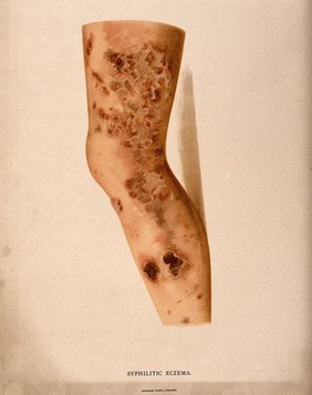 A section of leg with a skin disease. Chromolithograph, c. 1888.